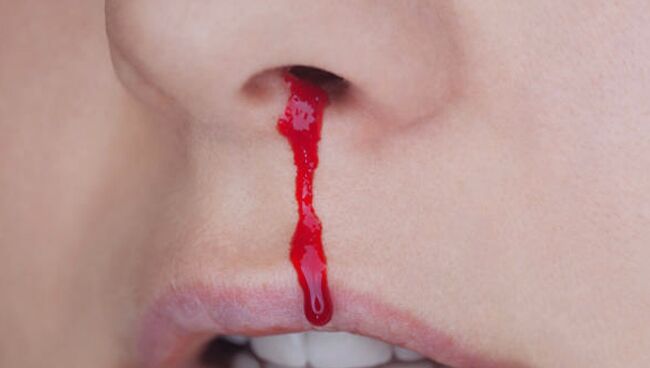 Приснилась кровь из носа 